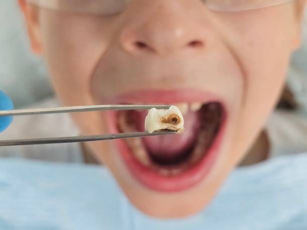 Best Emergency Tooth Extraction in El Dorado Springs, MO