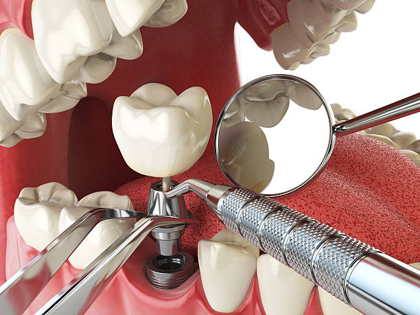 Best Emergency Dental Care for Broken or Chipped Teeth in El Dorado Springs, MO